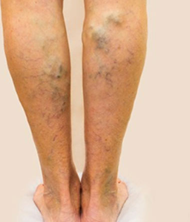 Debunking the Myths of Varicose Veins