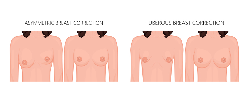 Asymmetrical, Tubular and Accessory Breasts - Kauvery Hospital