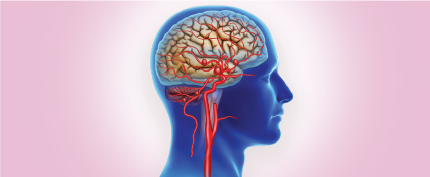 Brain Aneurysm 
