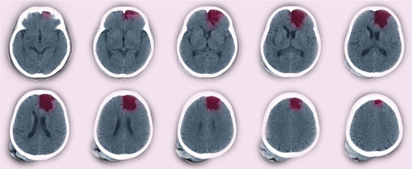 Brain lesions