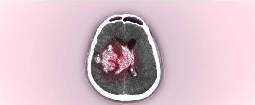 Cerebral Contusion and Intracerebral Hematoma