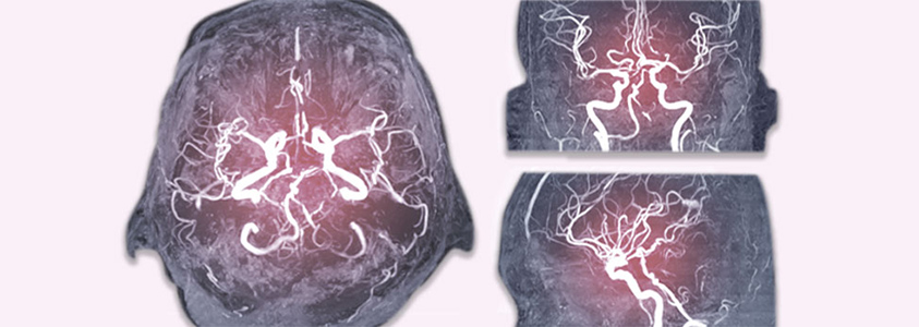 Embolic Stroke