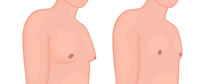 Male Breast Reduction Surgery