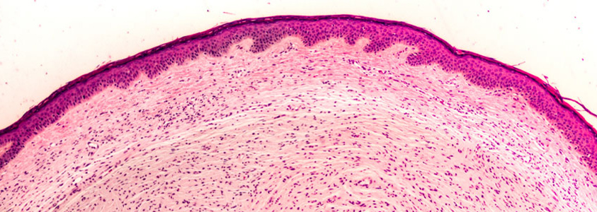 Neurofibromatosis