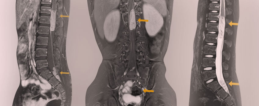 Spinal Cord Tumors