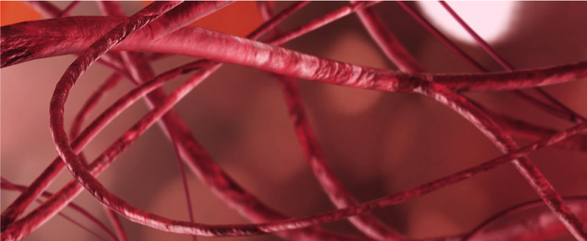 Arteriovenous Malformation