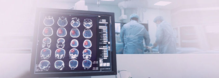 What is a Stroke?