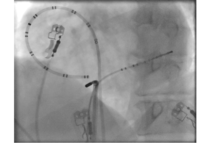 Cardiac Electrophysiology | Best Cardiac Electrophysiologist | Kauvery ...