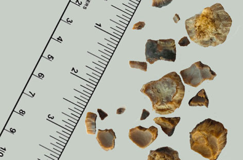 causes kidney stones