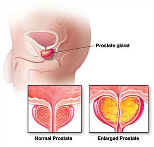 enlarged prostrate