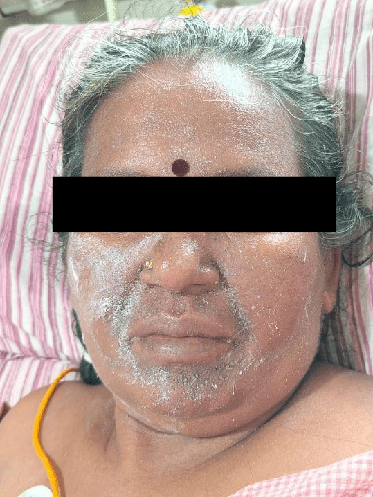 Drug-Induced Hypersensitivity to Salazopyrin: Case Report & Management ...