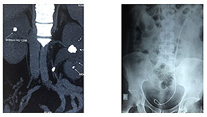 urinary stone 3