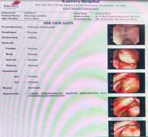 Triple Bypass Case Report – Complex GI Surgery | Kauvery Hospital ...