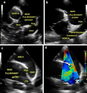 Patent Ductus Arteriosus (PDA) - Kauvery Hospital