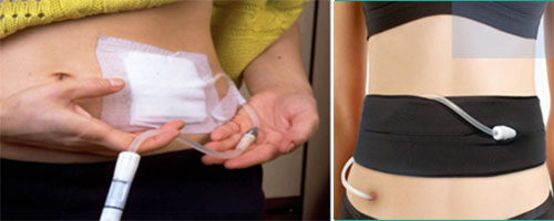 CAPD Catheter and Pouch
