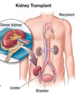Kidney Transplant Schematic Diagram