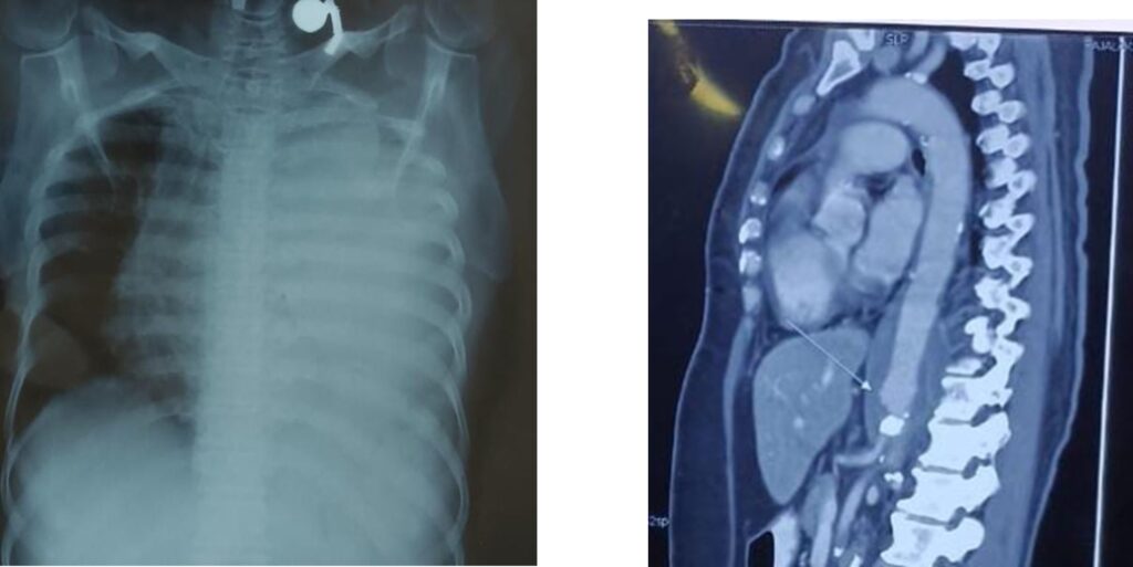 Ruptured Thoraco-Abdominal Aortic Aneurysm with Massive Hemothorax ...