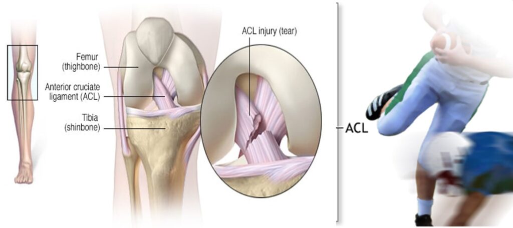 ACL Rehabilitation: Physiotherapy Case Report | Kauvery Hospital