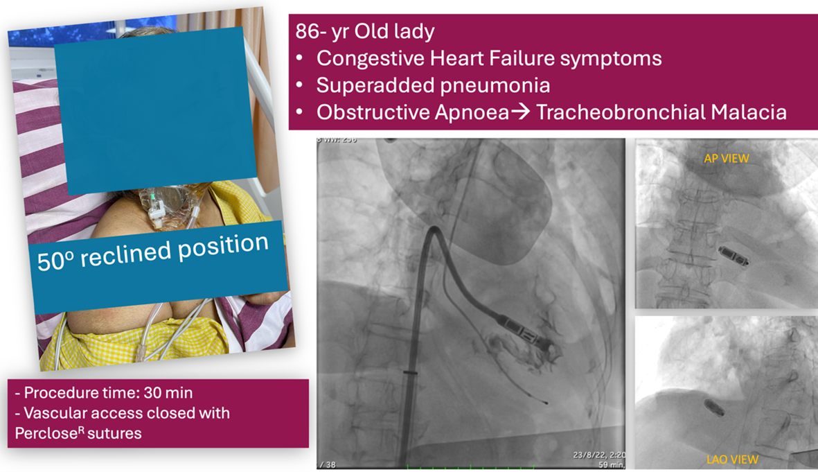 Second generation of Leadless pacemakers- the Micra-AVTM