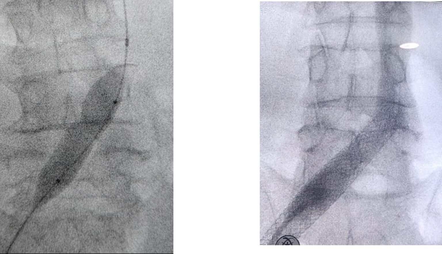 Interventions in Acute Ilio-Femoral DVT – 5 Years Institutional ...