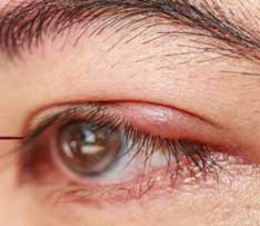 Lid Infections