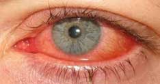 Ocular Surface Infections: