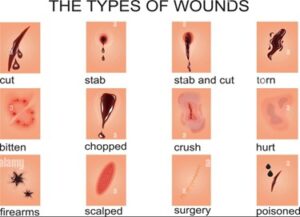 Break In Skin Wound Care Guide: Assessment, Treatments & Dressings | Kauvery Hospital
