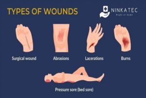 Break In Skin Wound Care Guide: Assessment, Treatments & Dressings | Kauvery Hospital