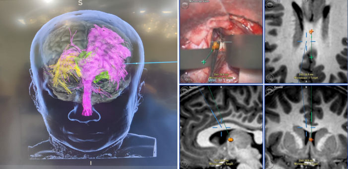 Understanding Minimally Invasive Brain and Spine Surgery - Appropriate Technology