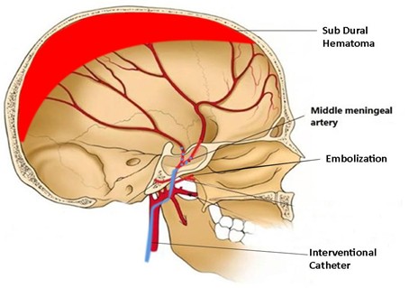 Illustration of Subdural Hematoma and the Embolization Procedure