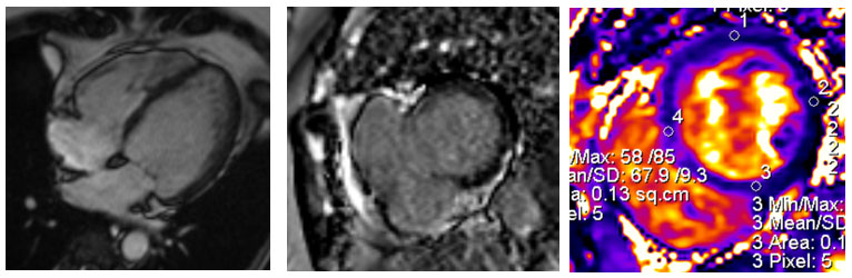 Advanced Imaging in Sports Cardiology
