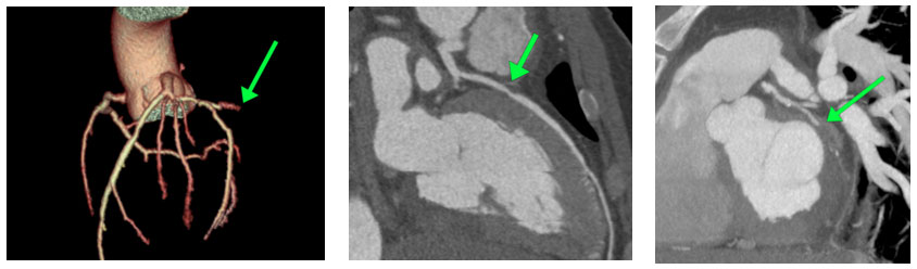Advanced Imaging in Sports Cardiology