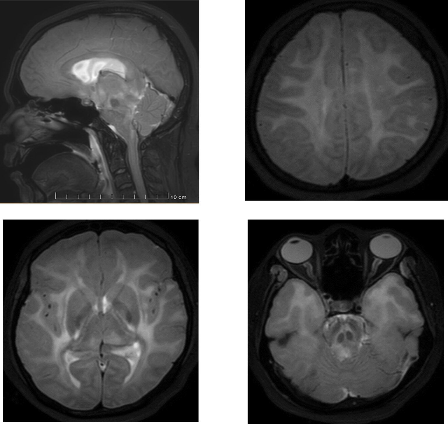 Neuroradiology nuggets: Fulminant cerebral edema in SLE associated ...