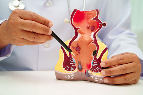 Common Perianal Surgical Problems in Women