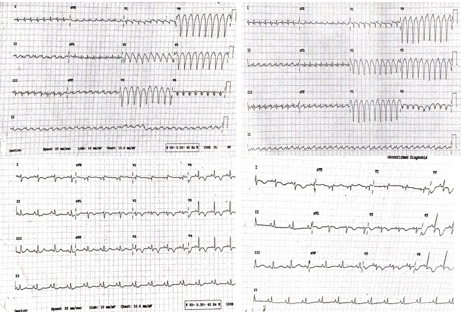 Arrhythmogenic right ventricular dysplasia presenting as ventricular ...